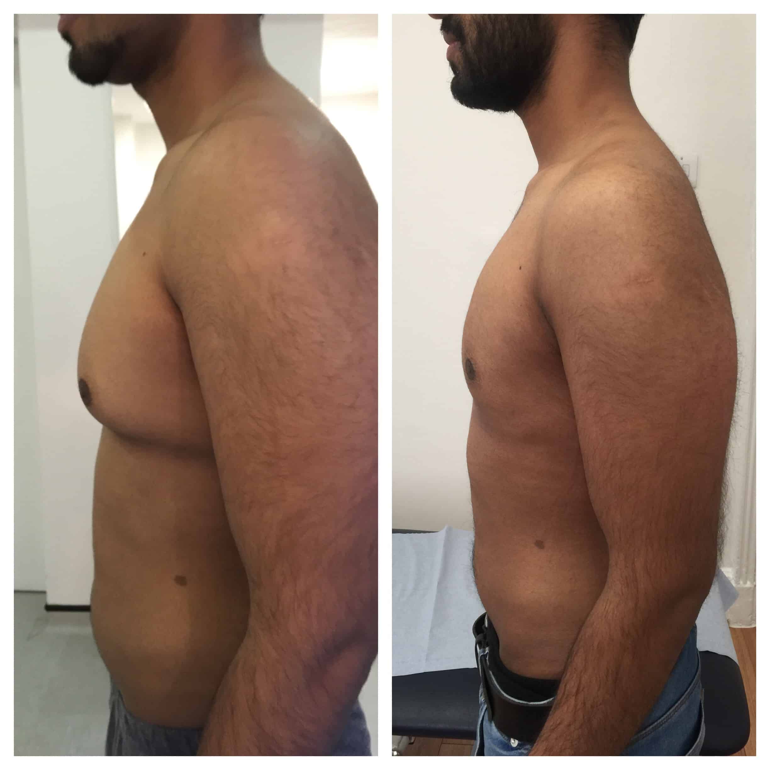 Vaser Lipo Centre